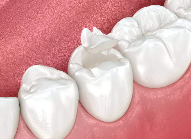 Best Dental Fillings (Composite and Amalgam)  in Oswego, NY